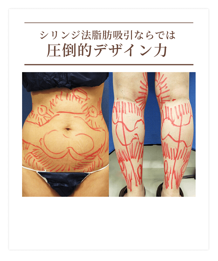 シリンジ法脂肪吸引ならでは圧倒的デザイン力