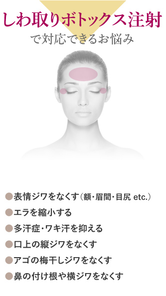 しわ取りボトックス注射で対応できるお悩み ●表情ジワをなくす（額・眉間・目尻 etc.） ●エラを縮小する ●多汗症・ワキ汗を抑える ●口上の縦ジワをなくす ●アゴの梅干しジワをなくす ●鼻の付け根や横ジワをなくす