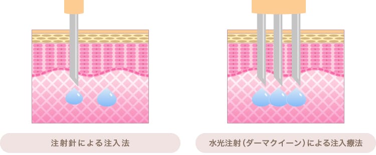 注射針と水光注射（ダーマクイーン）による注入の違い 