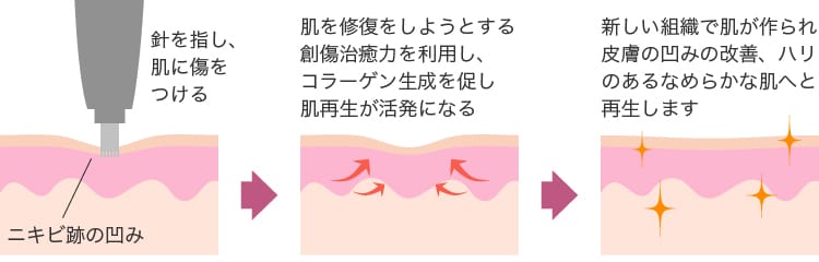 新宿 立川 横浜でダーマペン４なら 新宿美容外科クリニック 公式