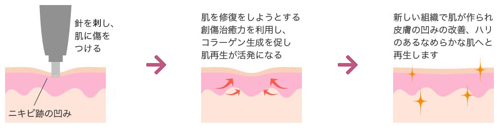 メカニズム