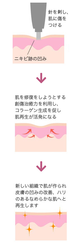 メカニズム