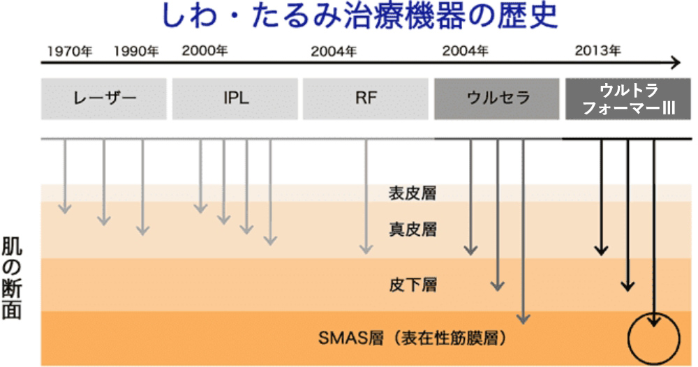 しみ・たるみ治療機器の歴史