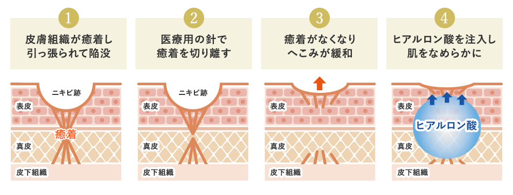 サブシジョンとは