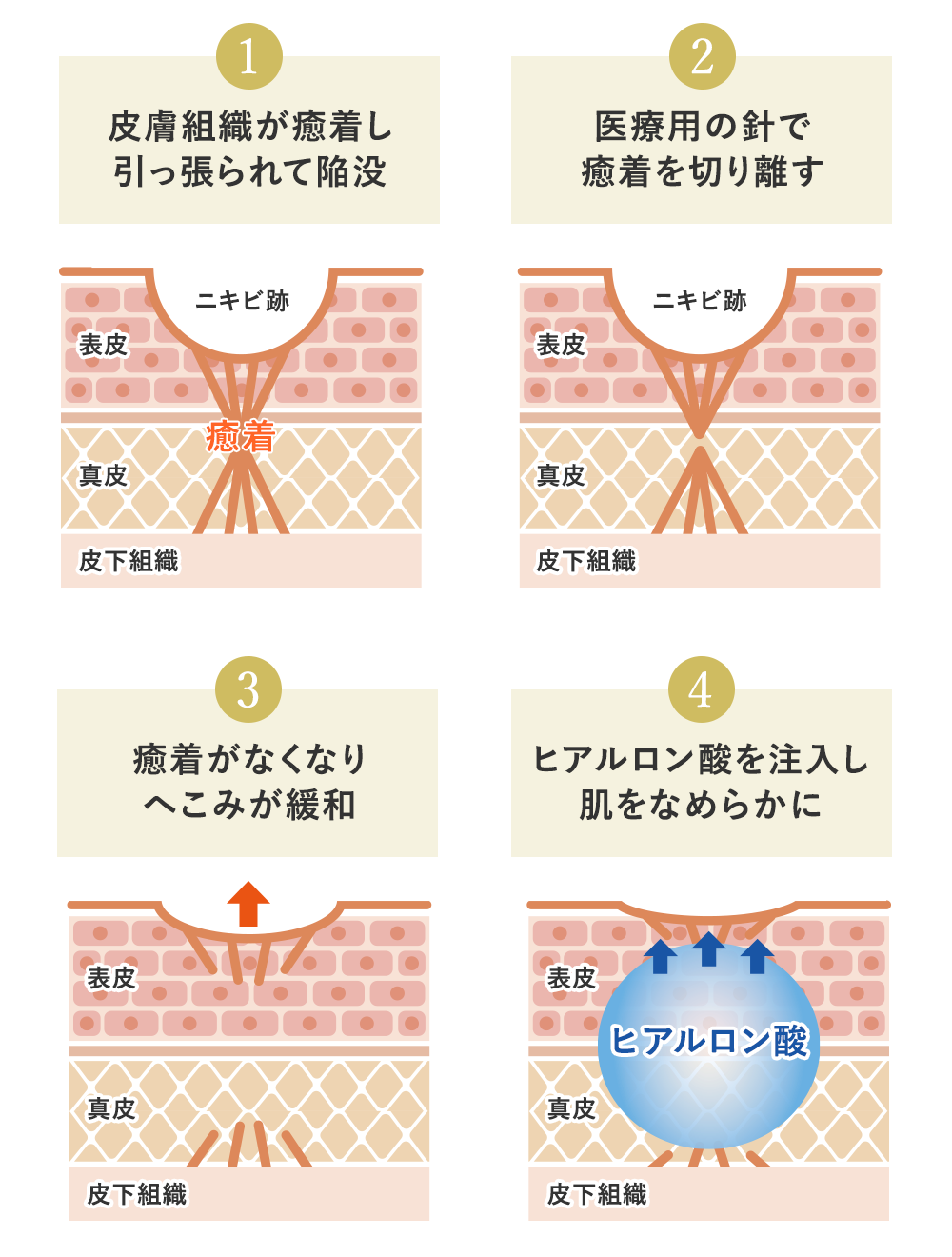 サブシジョンとは
