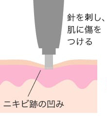 ダーマペンのメカニズム1