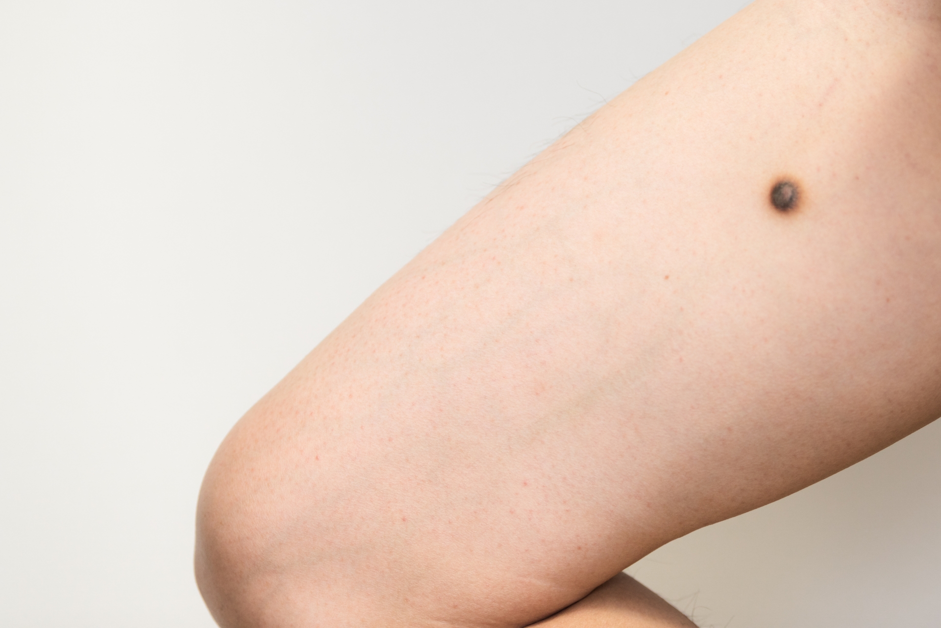 ほくろ周辺やほくろ毛は脱毛できる 安全な脱毛施術を実現するためには 新宿美容外科クリニック 新宿院 立川院 横浜院 公式 ほくろ周辺やほくろ毛は脱毛できる 安全な脱毛施術を実現するためには 新宿美容外科クリニック 新宿院 立川院 横浜院 公式