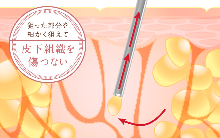 皮下組織を傷つけず出血量が少ないから手術後のダウンタイム回復が早い