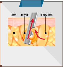 タイプ1