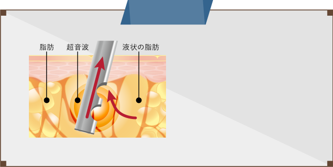 タイプ1